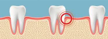 Root Canal Treatment in Lahore