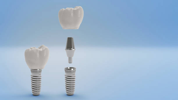 Affordable Dental Implants In Houston