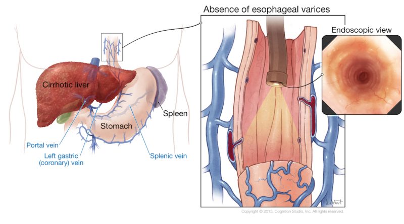 How to manage esophageal varices